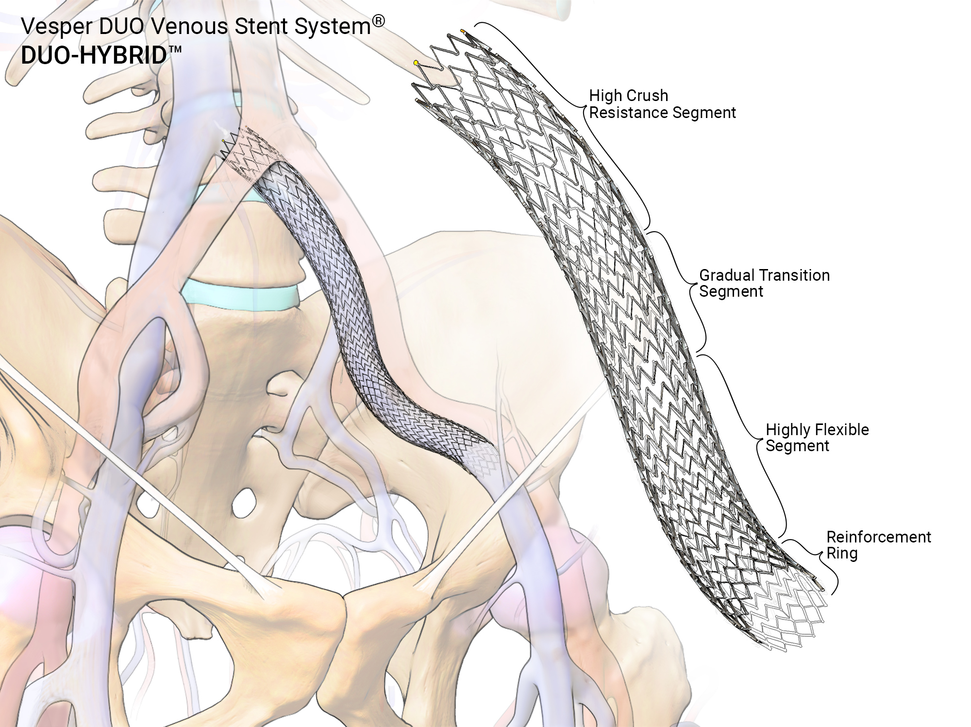 Vesper Medical Gilde Healthcare